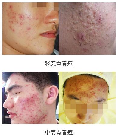 青春痘的类型