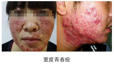 海口青春痘的症状类型