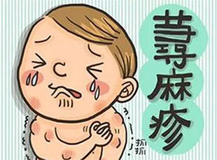 海口治疗荨麻疹