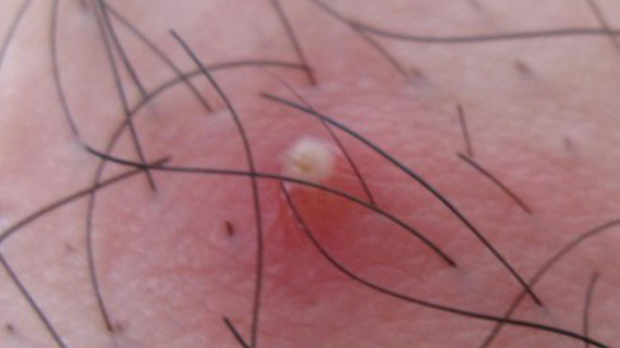 海口治疗毛囊炎哪里好?