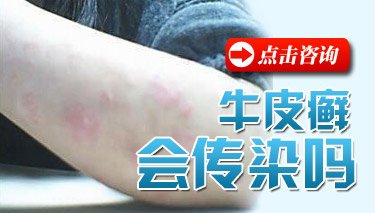 银屑病的早期症状