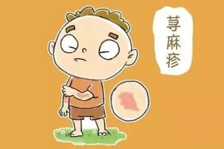 得了荨麻疹 这7种食物不能碰