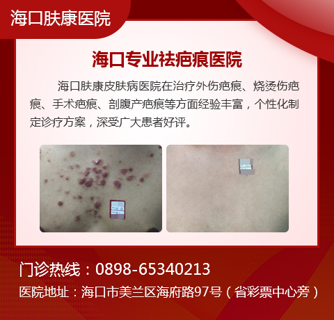 海口疤痕疙瘩修复好的医院