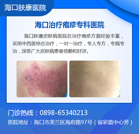 海口带状疱疹医院哪家正规