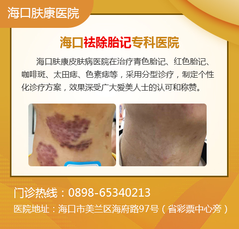 海口哪家医院做胎记好
