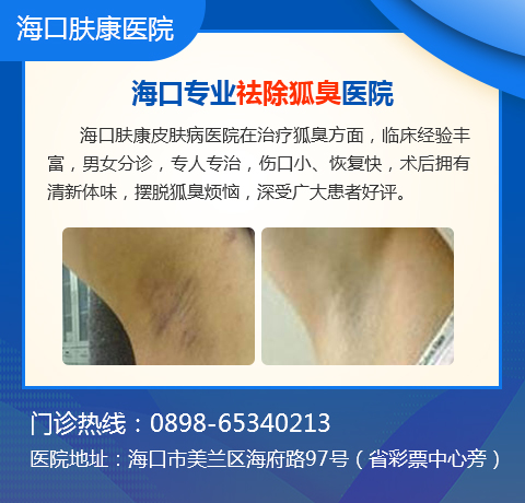 在海口治腋臭哪家医院比较好