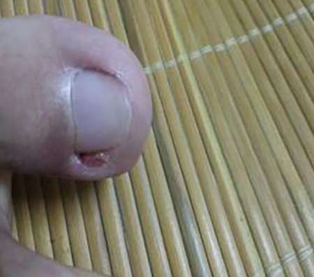 海口市哪家治疗甲沟炎医院好