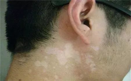 海口哪里治汗斑治的好
