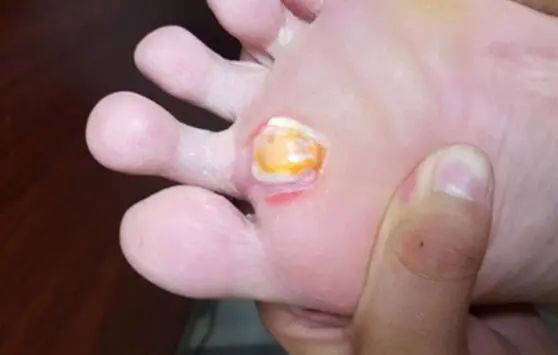 在海口去哪里治鸡眼